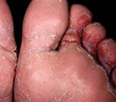 The Natural Cure For Athlete's Foot